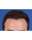 After Hair Transplant&nbsp;Hairlines